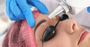 remoção de sobrancelha a laser