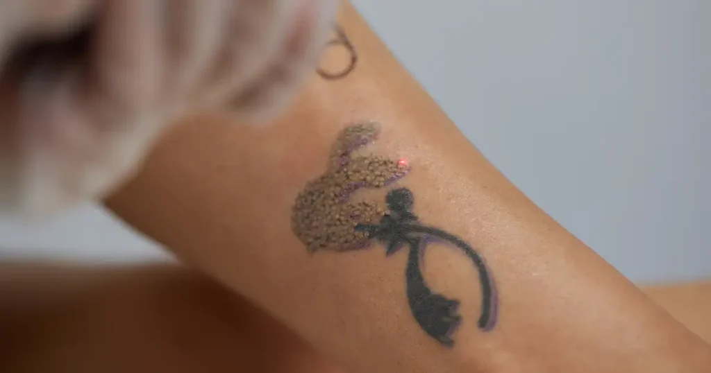 remoção de tatuagem e sobrancelha no alagarve