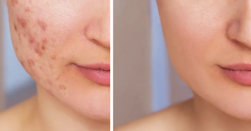 tratamento para acne no algarve